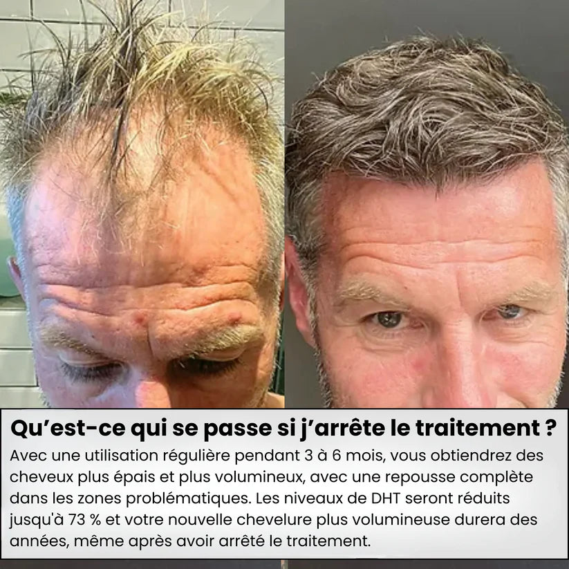 Système de repousse des cheveux AlphaInfuse™