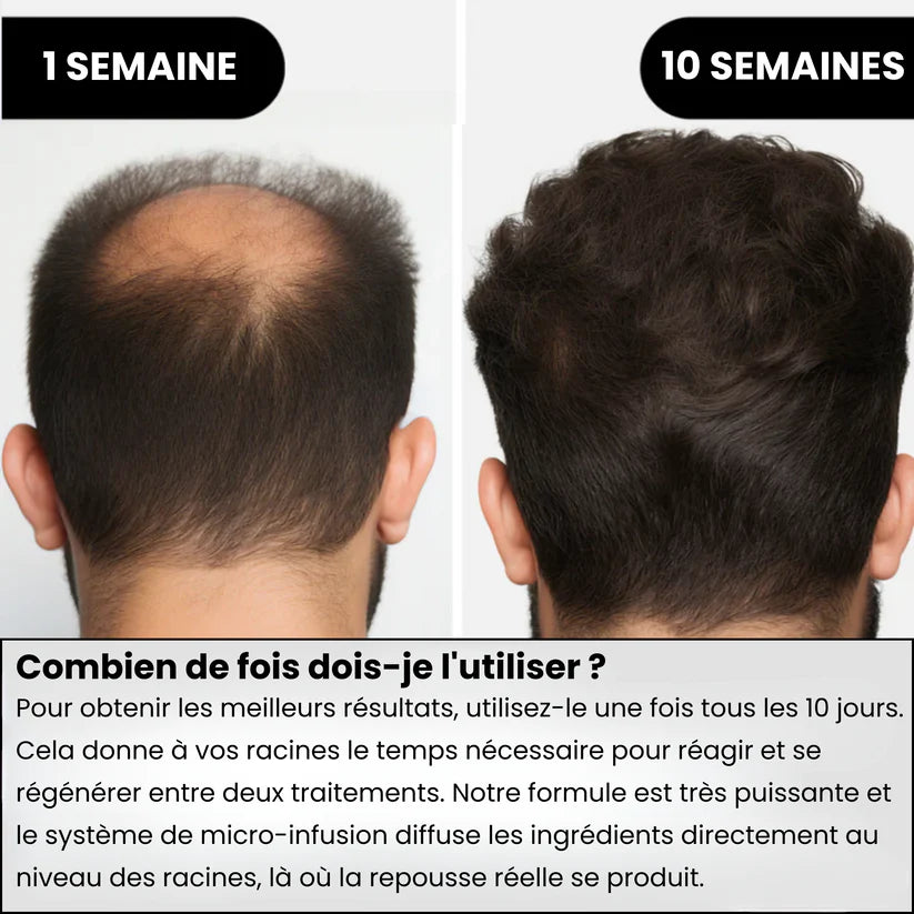 Système de repousse des cheveux AlphaInfuse™
