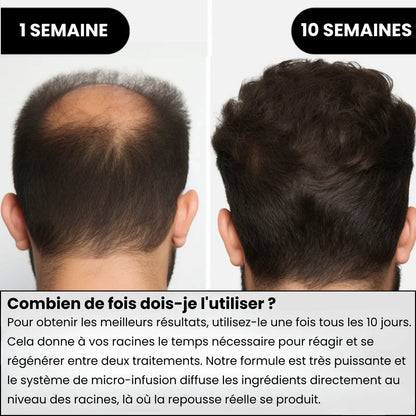 Système de repousse des cheveux AlphaInfuse™