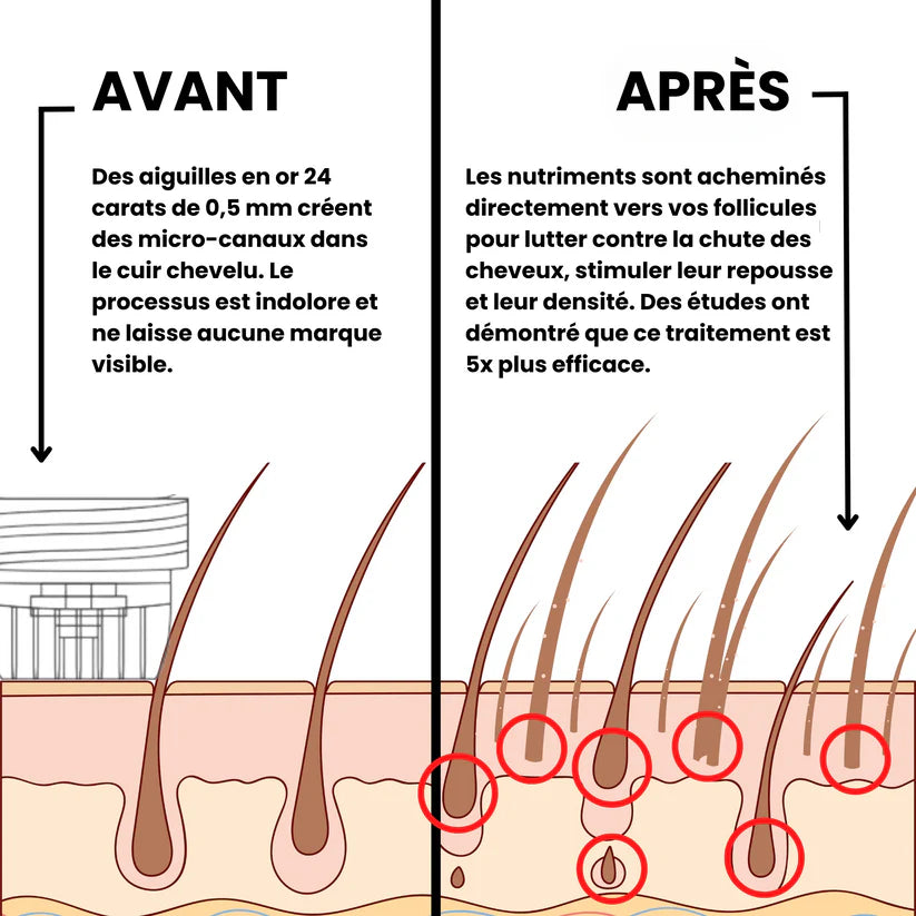 Système de repousse des cheveux AlphaInfuse™